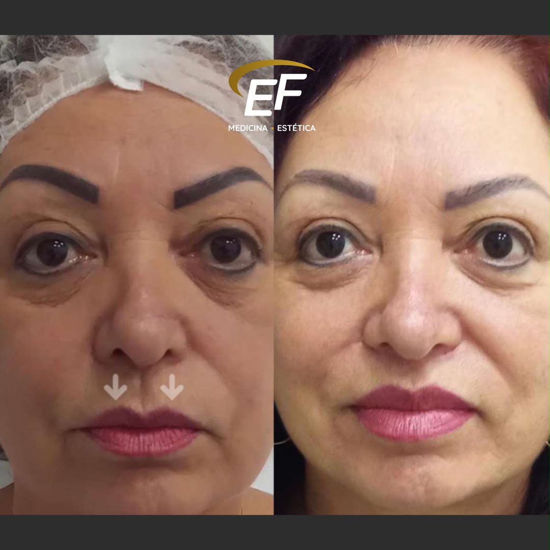 Resultado antes e depois — Estetic Face