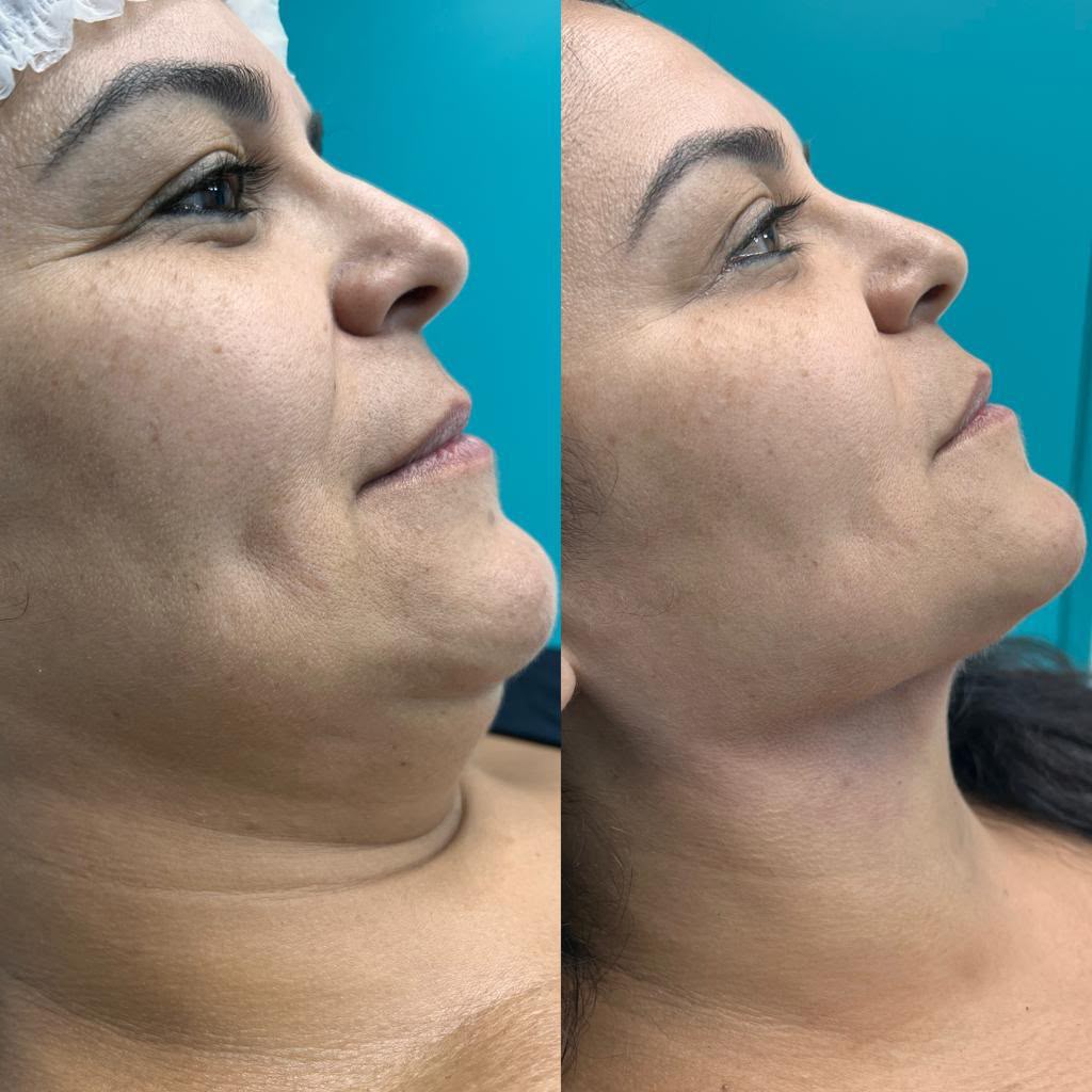 Resultado antes e depois — Estetic Face