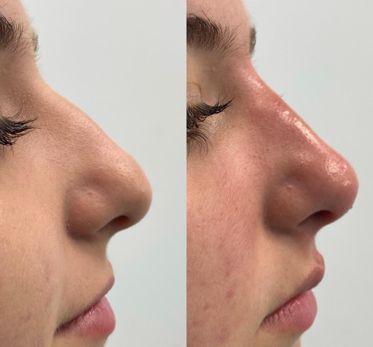 Resultado antes e depois — Estetic Face