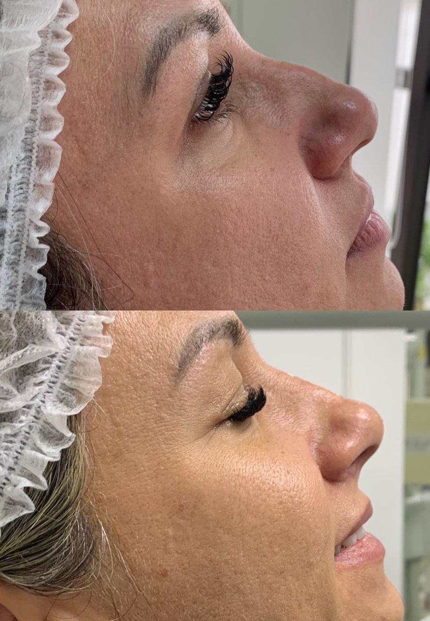 Resultado antes e depois — Estetic Face
