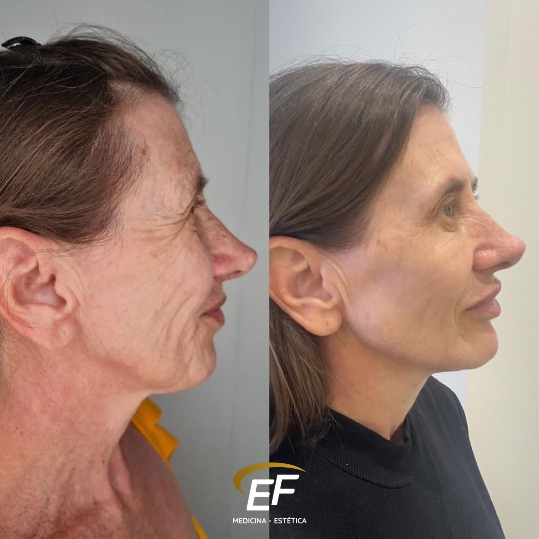 Resultado antes e depois — Estetic Face