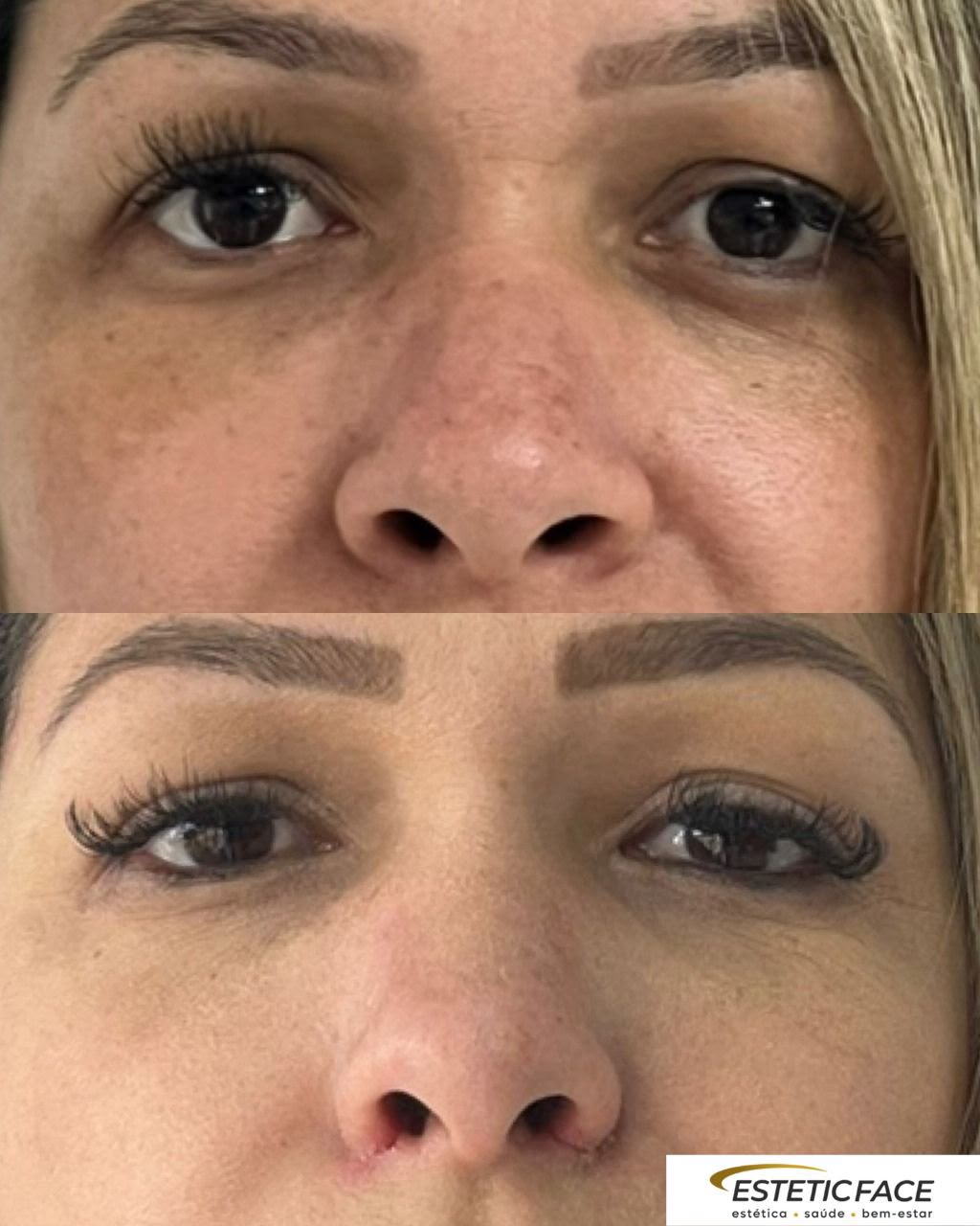 Resultado antes e depois — Estetic Face