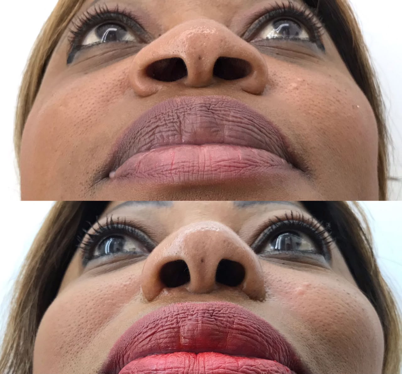 Resultado antes e depois — Estetic Face