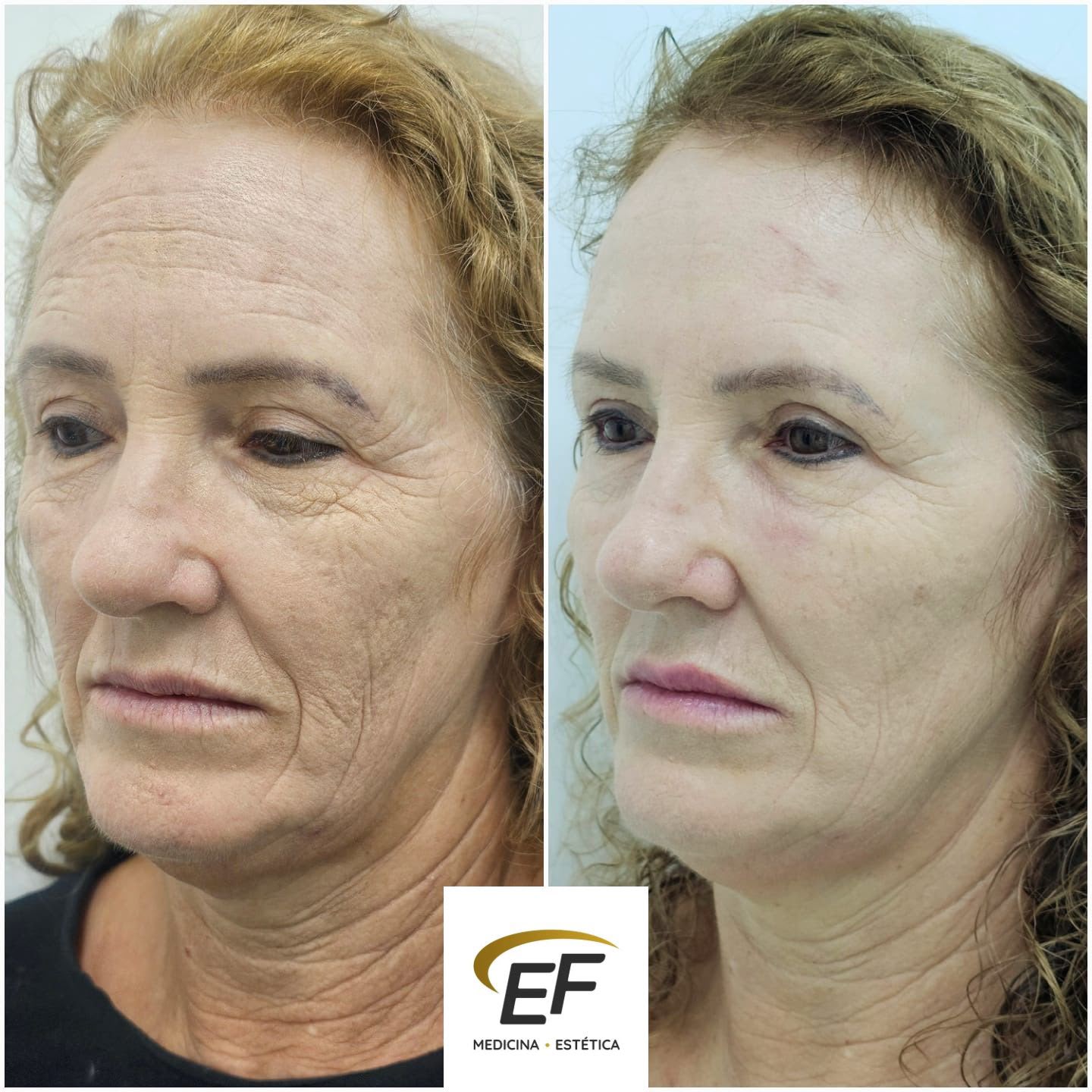 Resultado antes e depois — Estetic Face