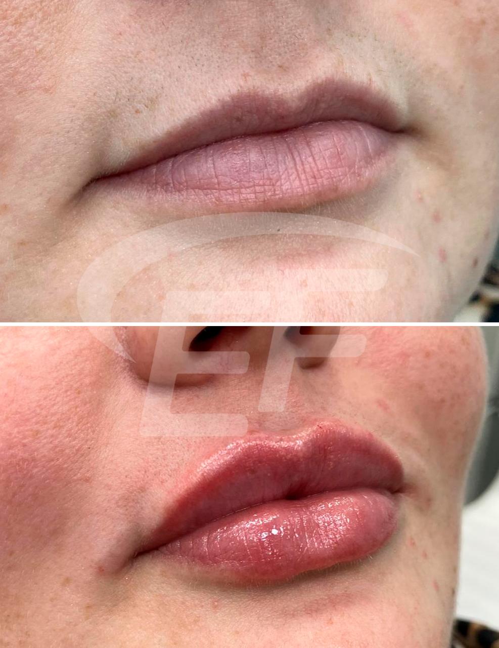 Resultado antes e depois — Estetic Face