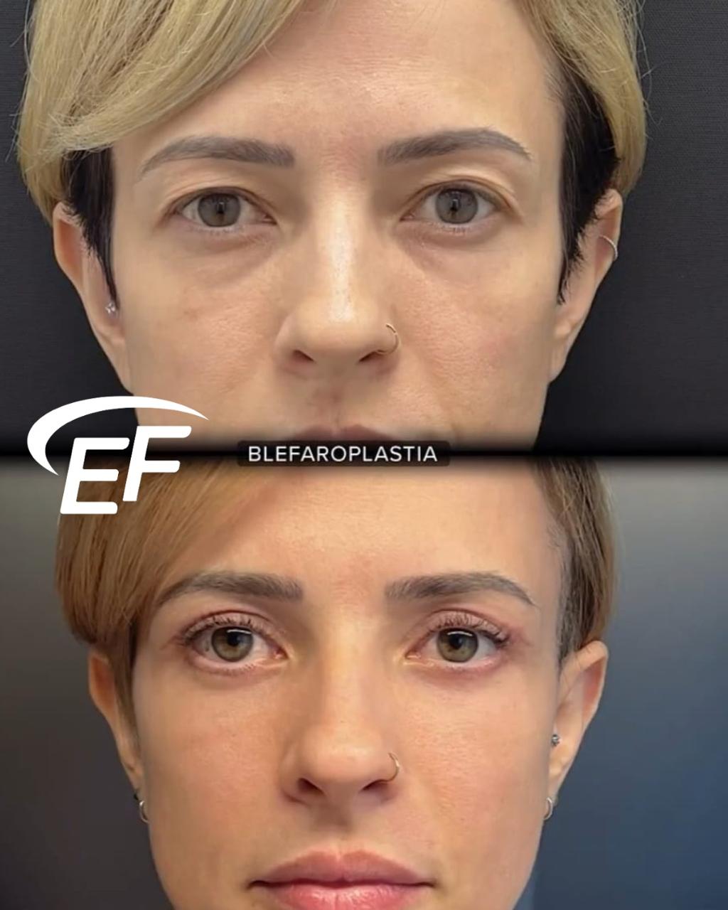 Resultado antes e depois — Estetic Face