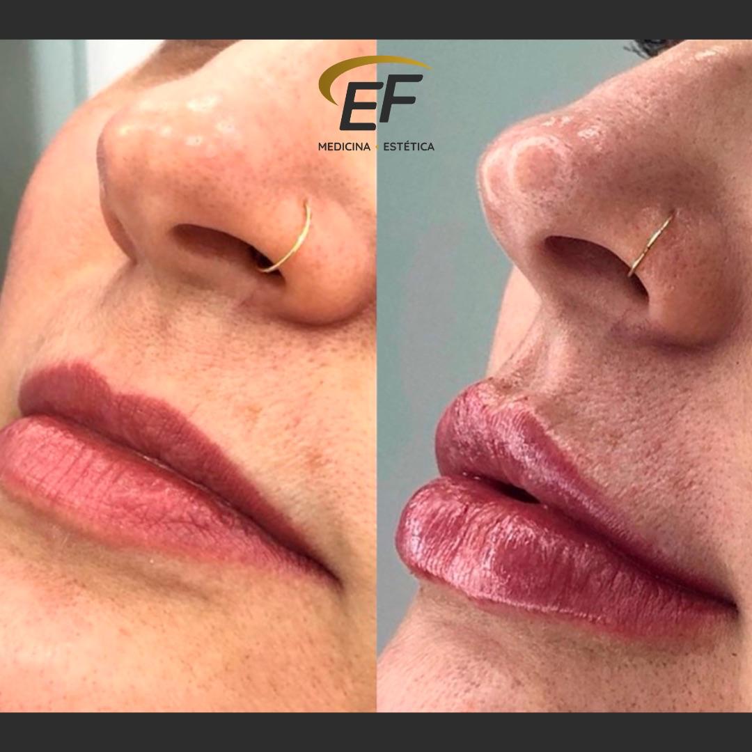 Resultado antes e depois — Estetic Face